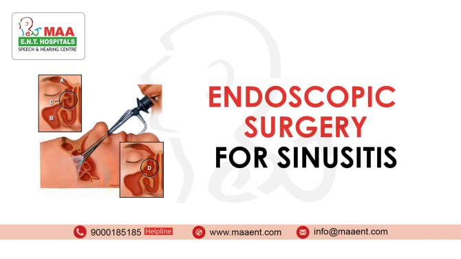 Endoscopic Sinus Surgery. How do they do it?